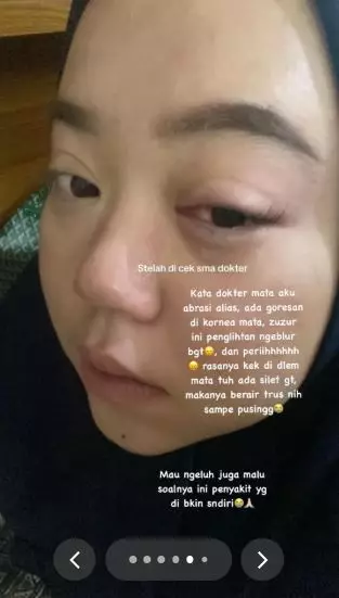 Efek pasang eyelash sendiri berujung kornea luka TikTok Efek pasang eyelash sendiri berujung kornea luka TikTok