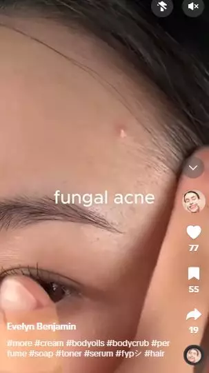 Tepung beras dicampur 2 bahan dapur bisa atasi fungal acne Berbagai sumber Tepung beras dicampur 2 bahan dapur bisa atasi fungal acne Berbagai sumber