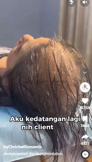 Cewek rambut tipis hampir botak usai treatment hasilnya bak hair extension TikTok