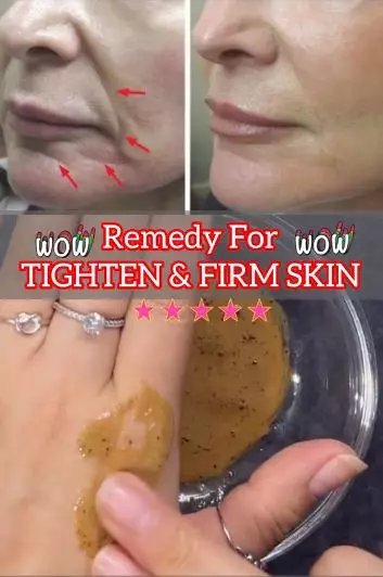 Cegah kulit mengendur dan cepat keriput Berbagai sumber Cegah kulit mengendur dan cepat keriput Berbagai sumber