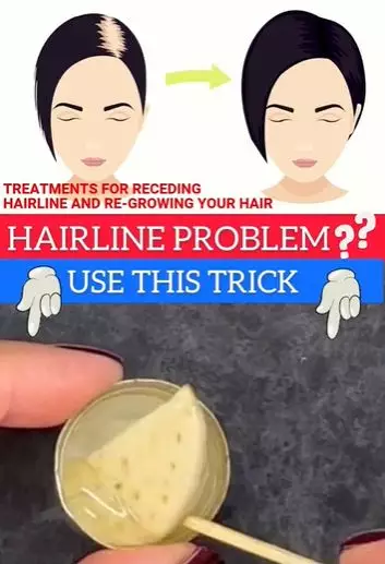 Tumbuhkan rambut tipis area depan Berbagai sumber Tumbuhkan rambut tipis area depan Berbagai sumber