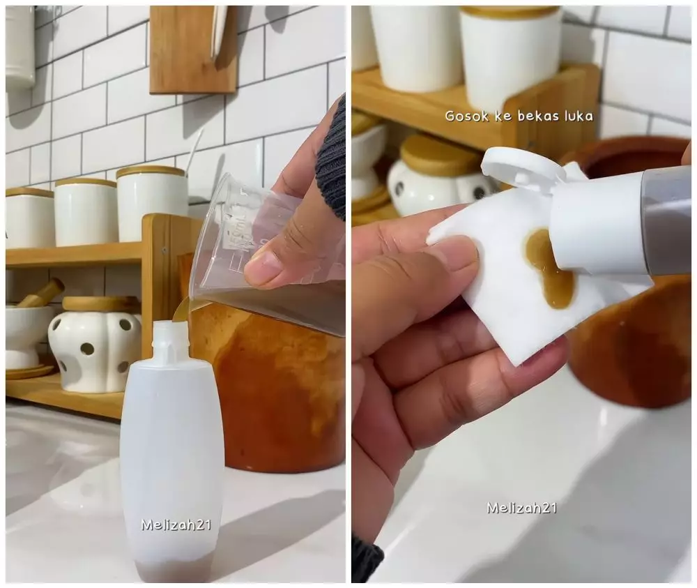 cara menghilangkan bekas luka secara alami © Instagram