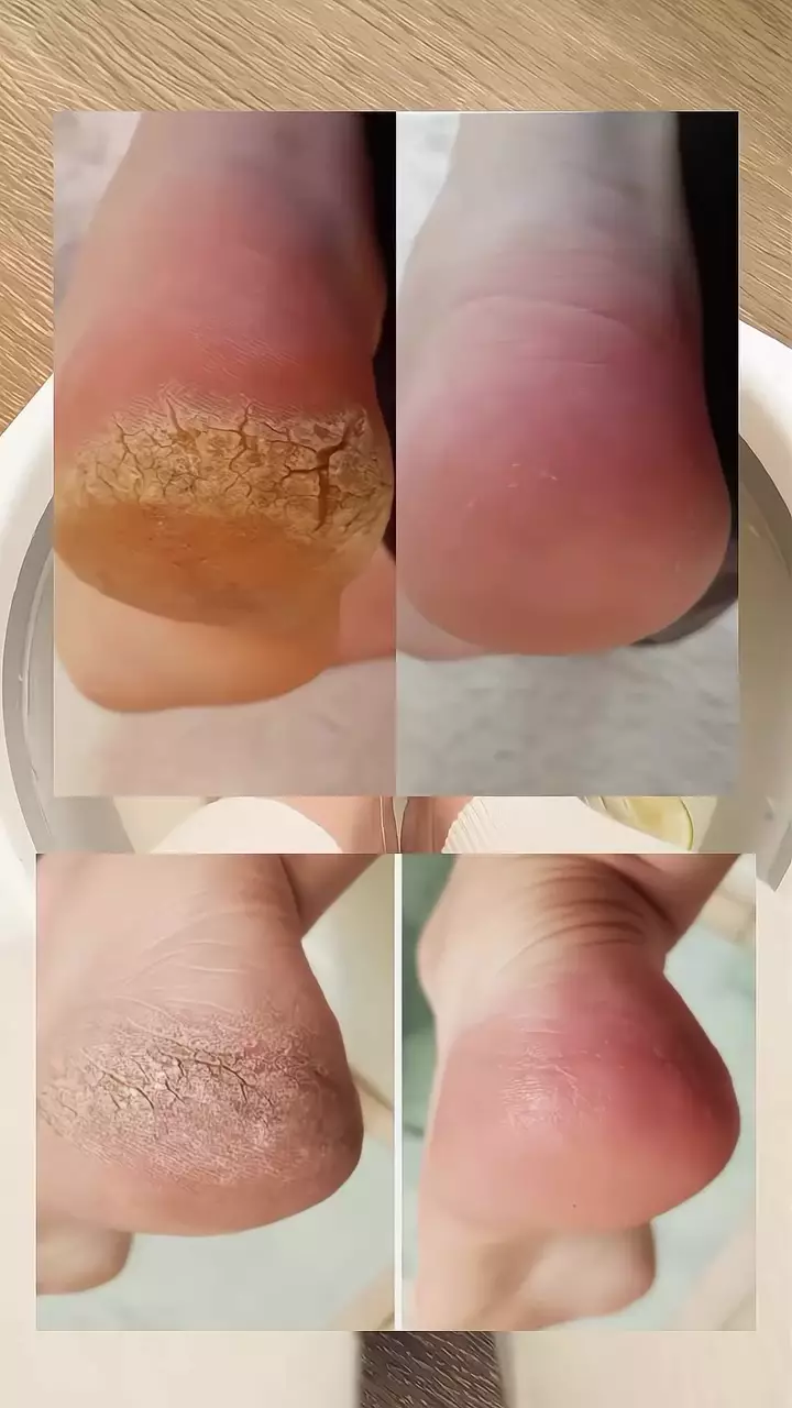 Cara mengatasi kaki kering dan pecah-pecah © Instagram Cara mengatasi kaki kering dan pecah-pecah © Instagram