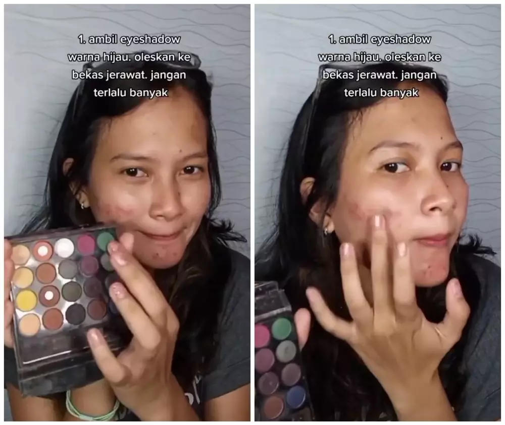 trik menutup bekas jerawat © YouTube