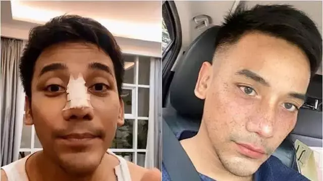 15 potret wajah seleb oplas dagu © 2025 brilio.net