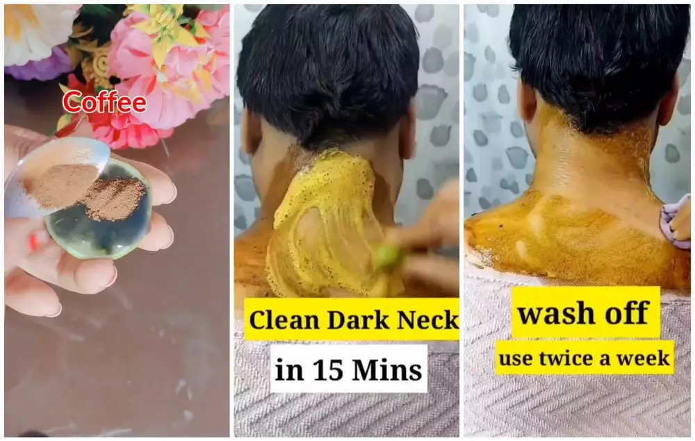 atasi punggung leher menghitam © Instagram