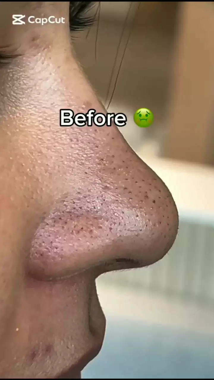 cara baru hempaskan komedo © Instagram 