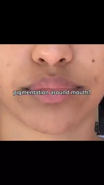 bibir gelap karena hiperpigmentasi © Instagram bibir gelap karena hiperpigmentasi © Instagram