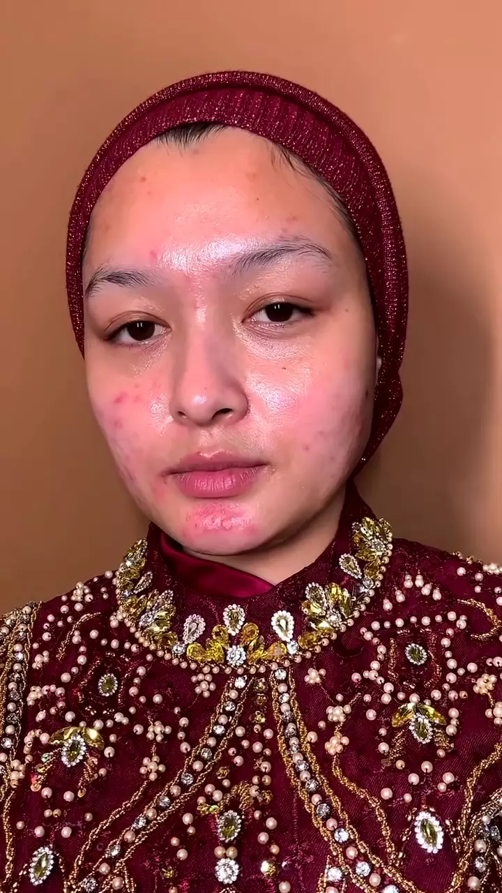 Wajah kemerahan akibat jerawat © Instagram Wajah kemerahan akibat jerawat © Instagram