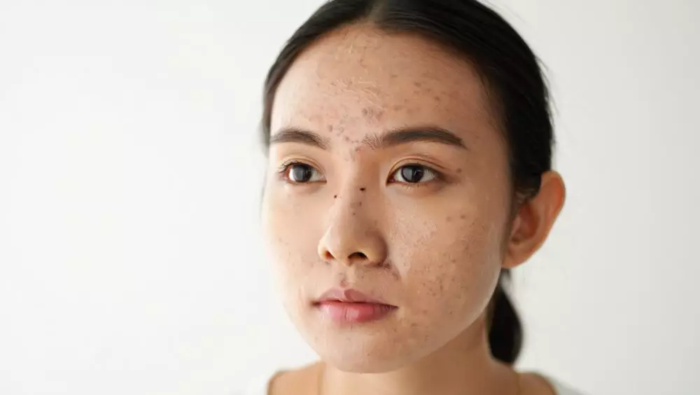 Cara menghilangkan komedo putih dan hitam di hidung © 2025 brilio.net