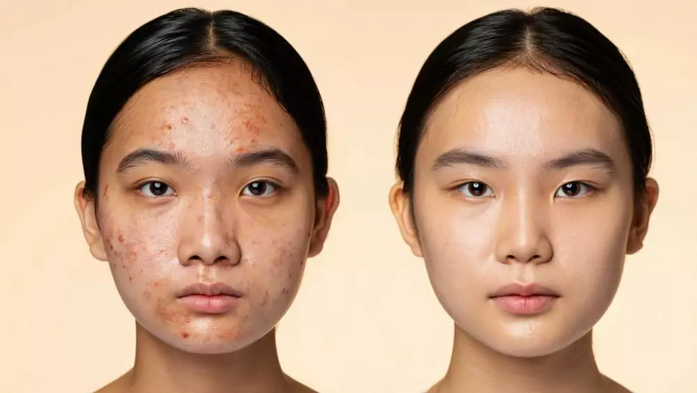 Bekas jerawat hilang dalam 7 hari © 2025 brilio.net