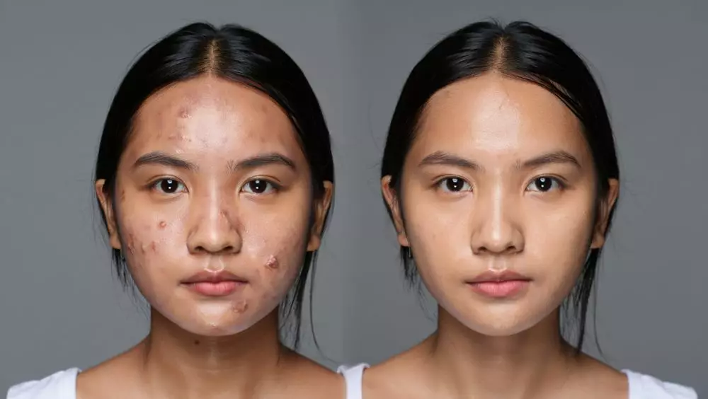 Tutorial makeup 2025 untuk nutupin jerawat © 2025 brilio.net Tutorial makeup 2025 untuk nutupin jerawat © 2025 brilio.net