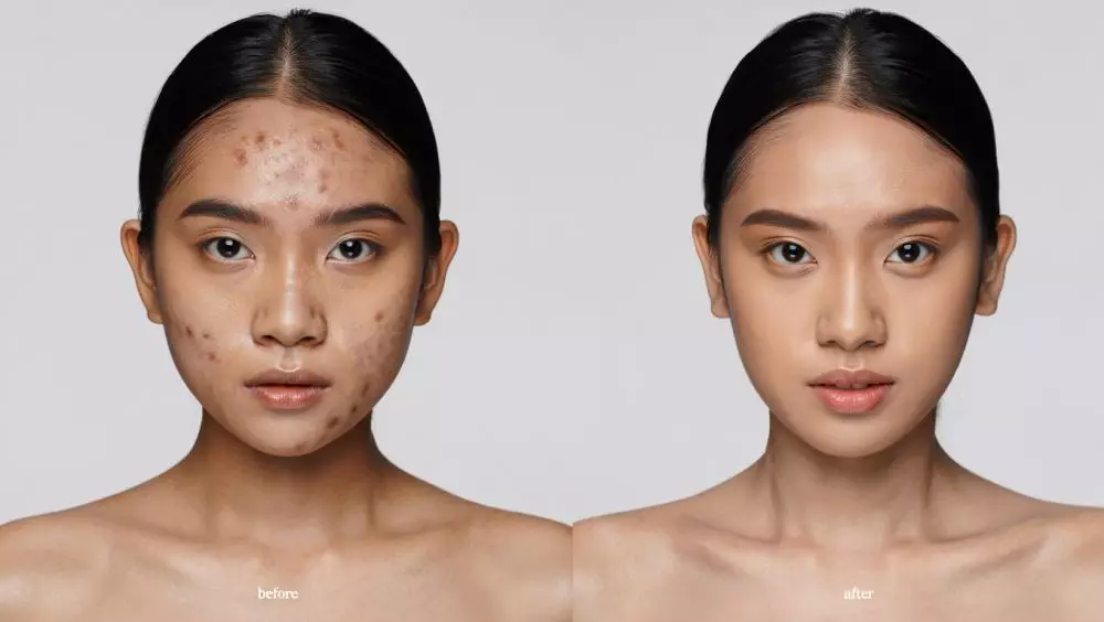 Cara pilih foundation sesuai jenis jerawat © 2025 brilio.net